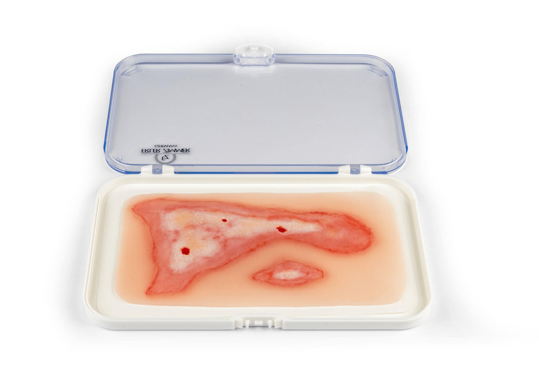 Wundmoulage Verbrühung - Erler - Zimmer